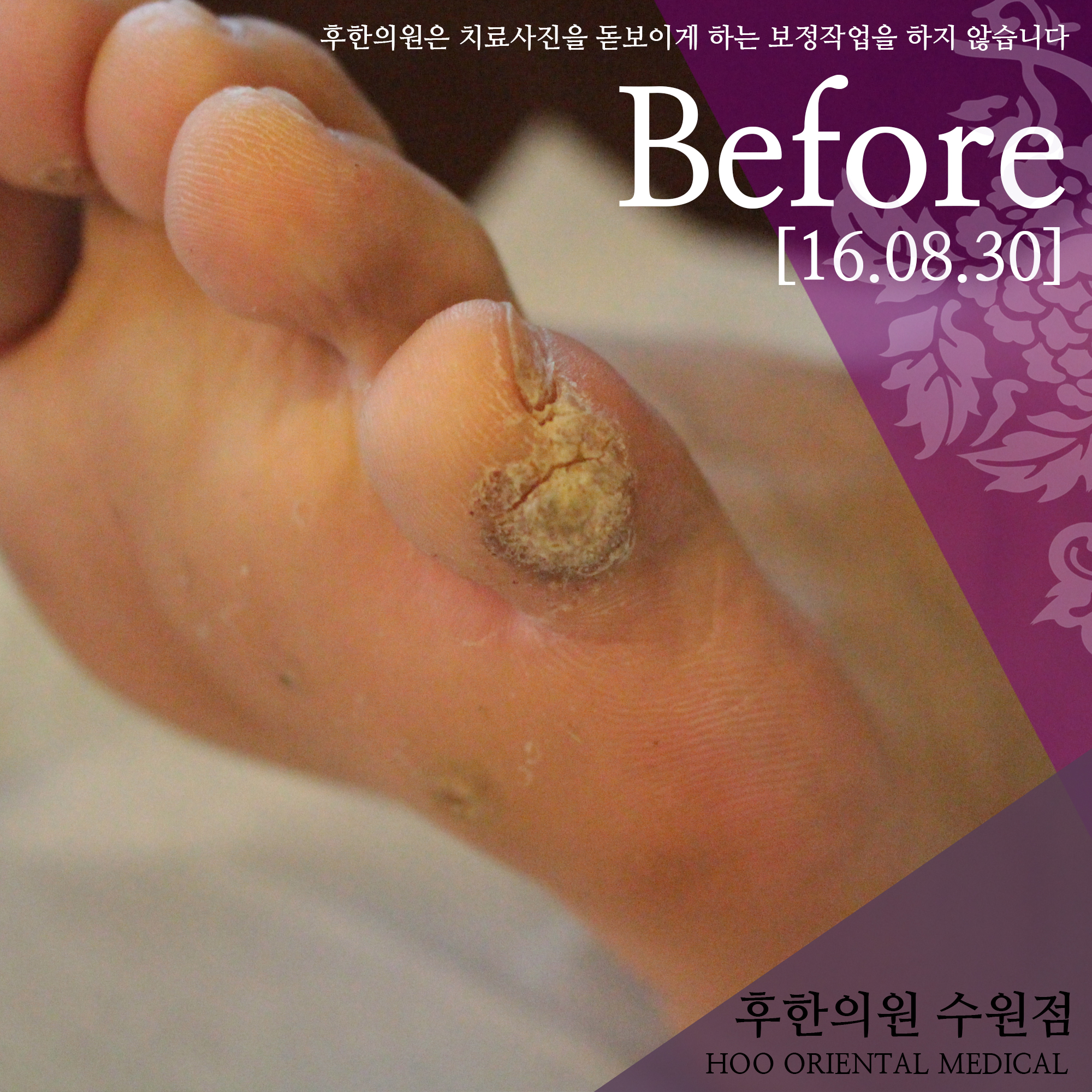 수원발사마귀치료 전