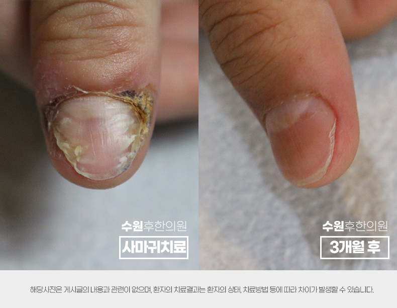 수원사마귀피부과 전후