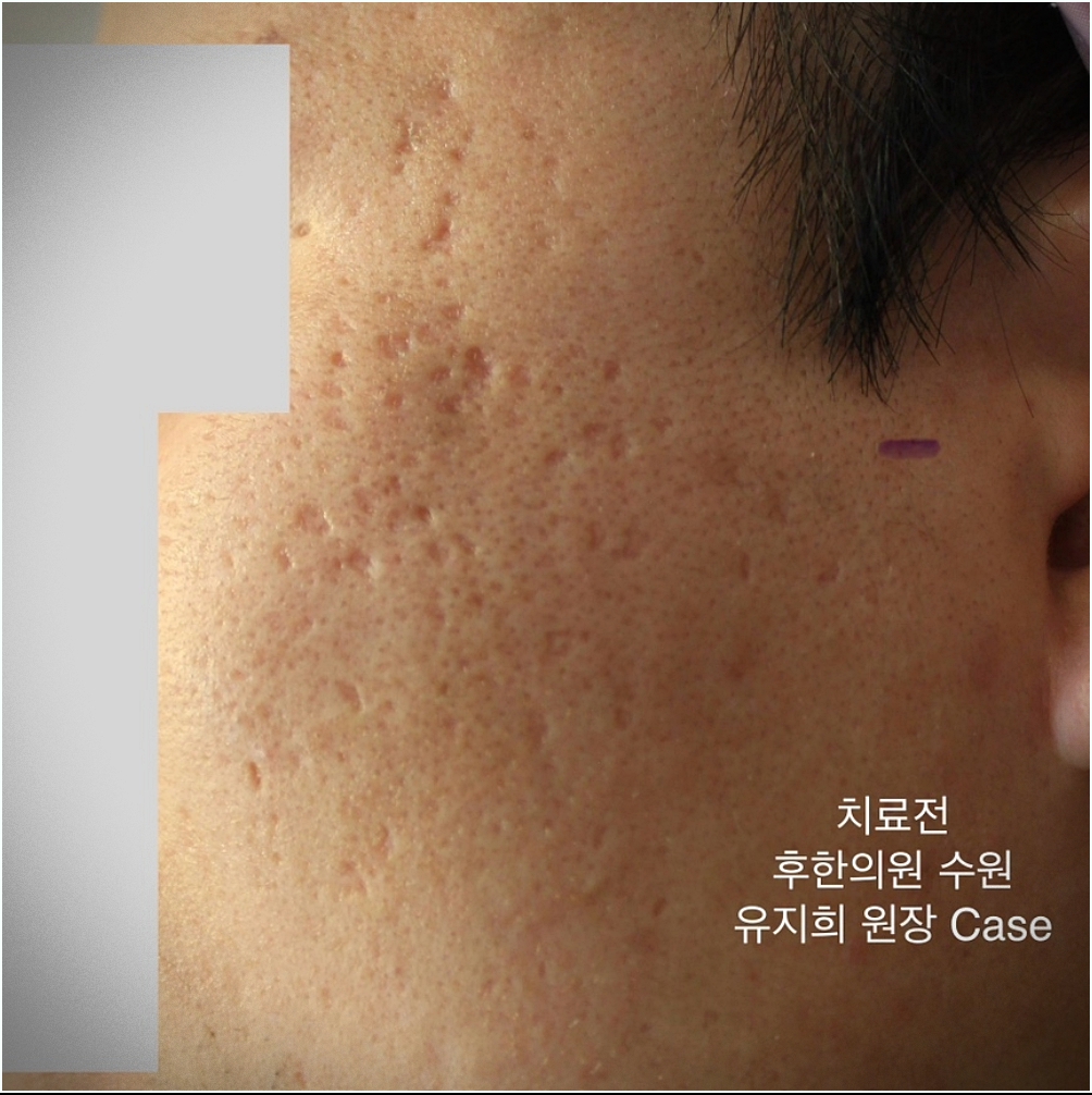 수원새살침 치료 전 패임 있는 상태
