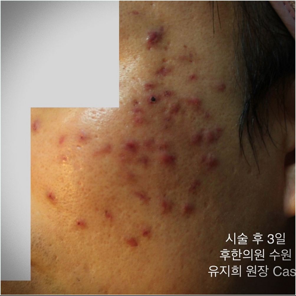 수원새살침 시술 후 3일차