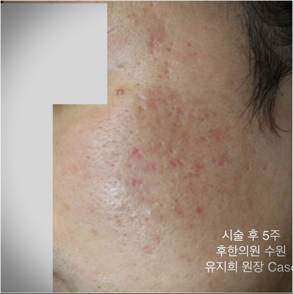 수원새살침 시술 후 5주차