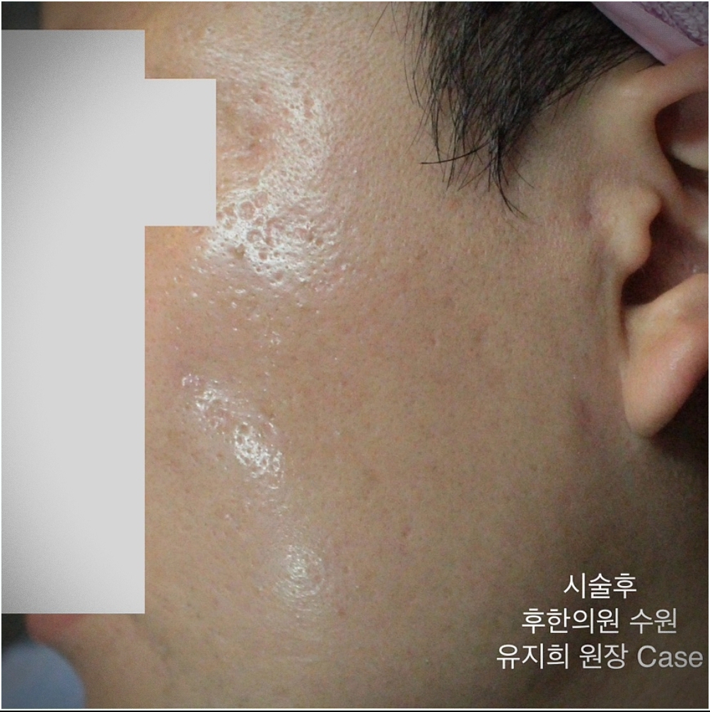 수원새살침 트랜스테라피 시술 후