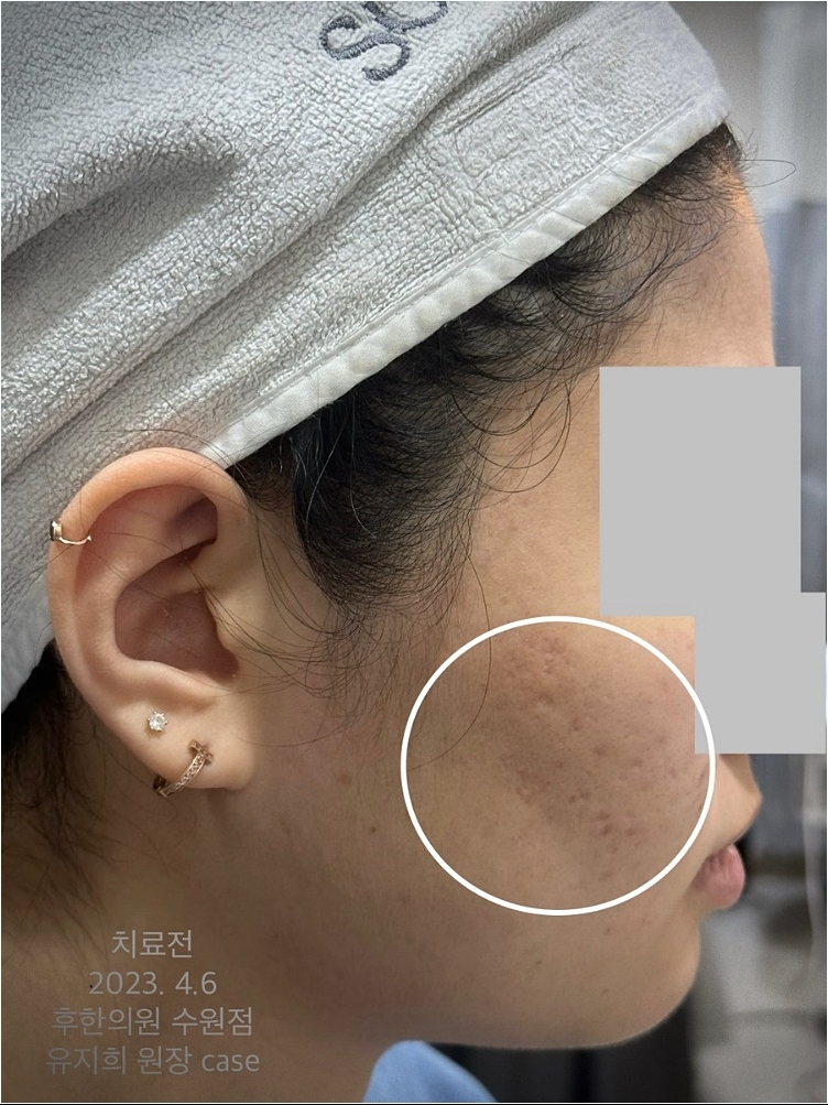수원여드름흉터 롤링성 등 흉터 있는 모습