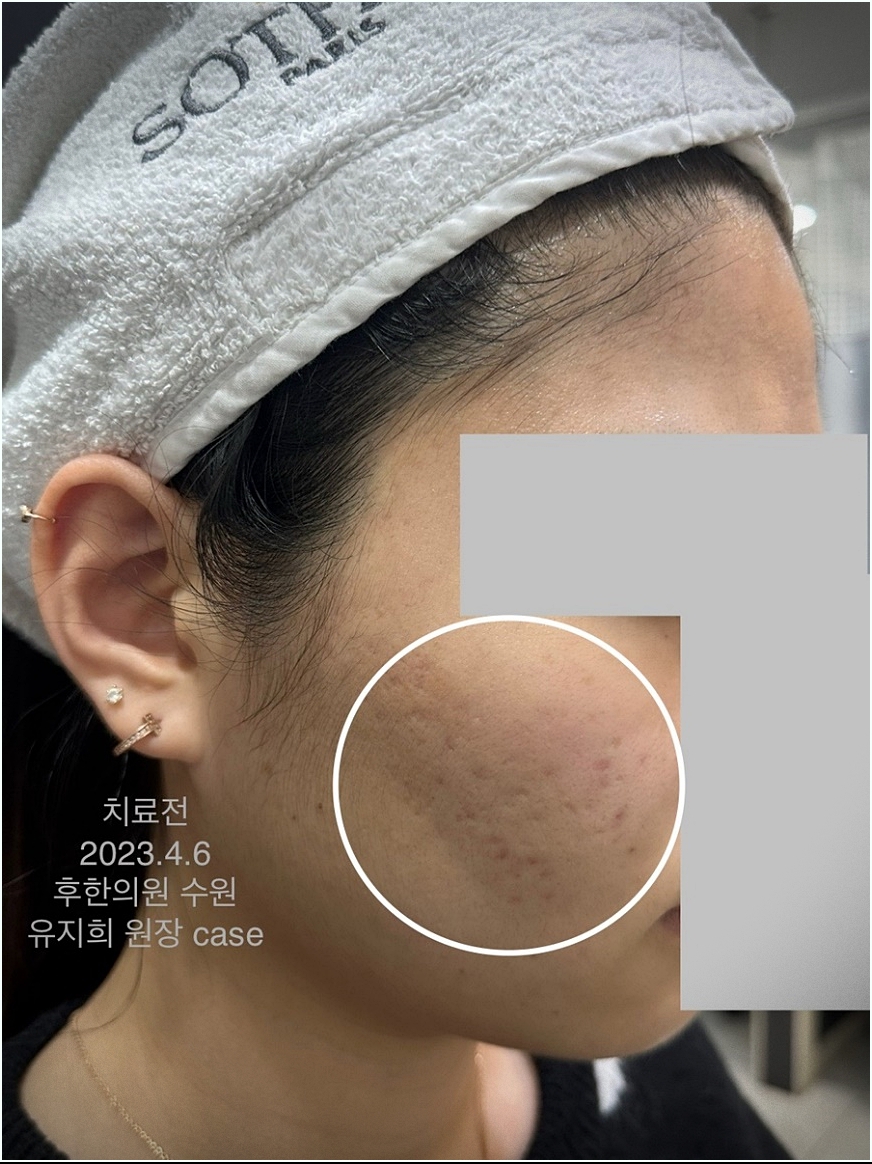 수원여드름흉터 치료 전 두번째