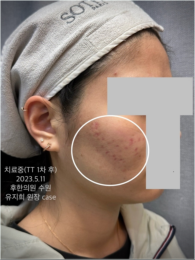 수원여드름흉터 티티 일차후 변화