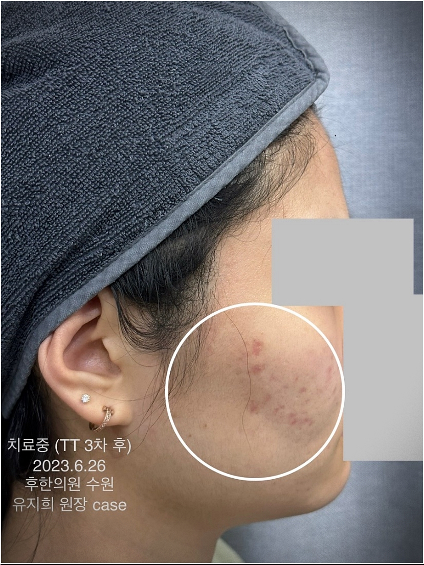 수원여드름흉터 티티 삼차후