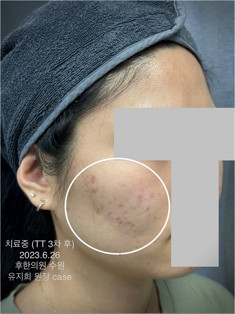 수원여드름흉터 치료중인 사진
