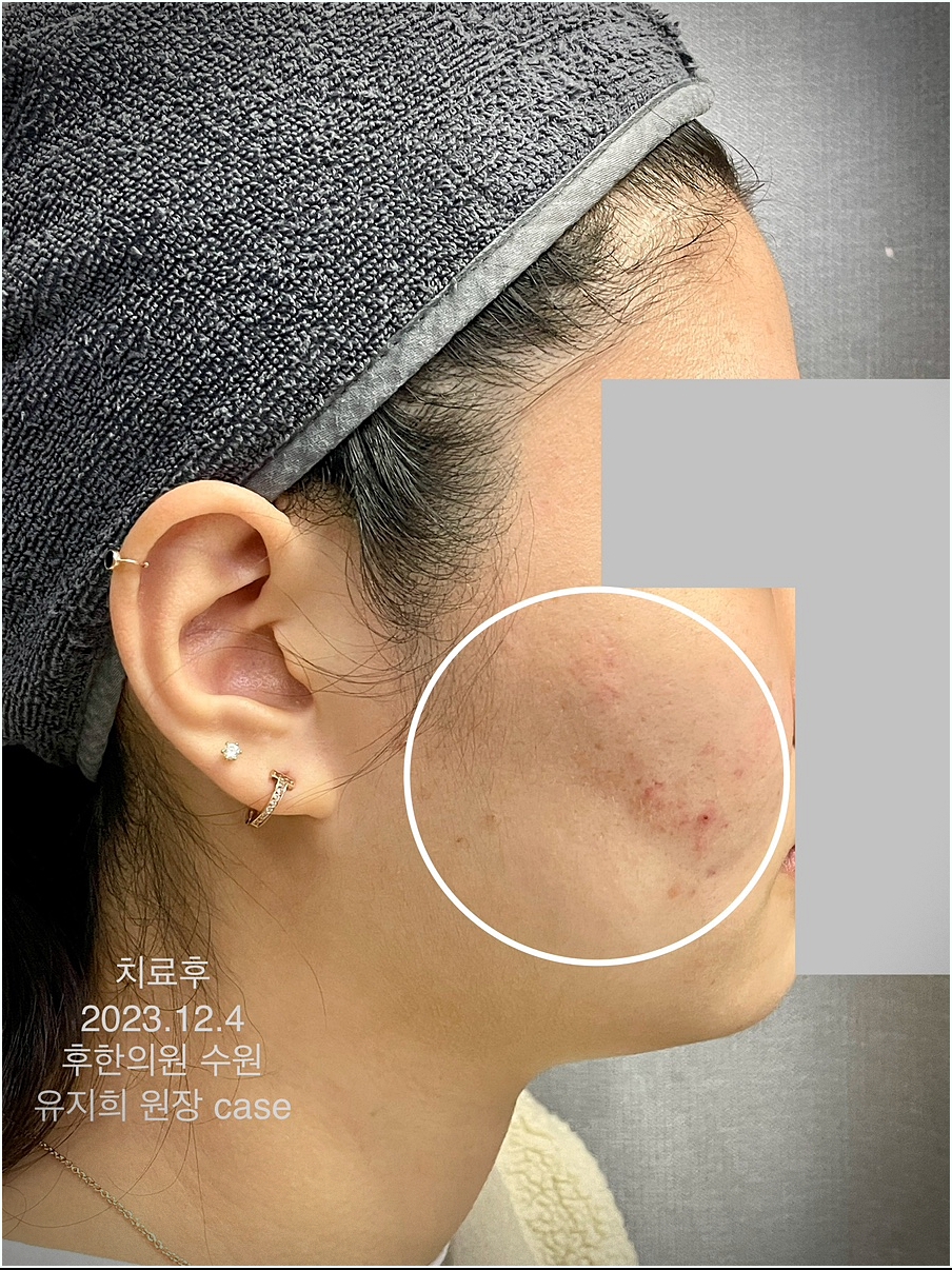 수원여드름흉터 치료후