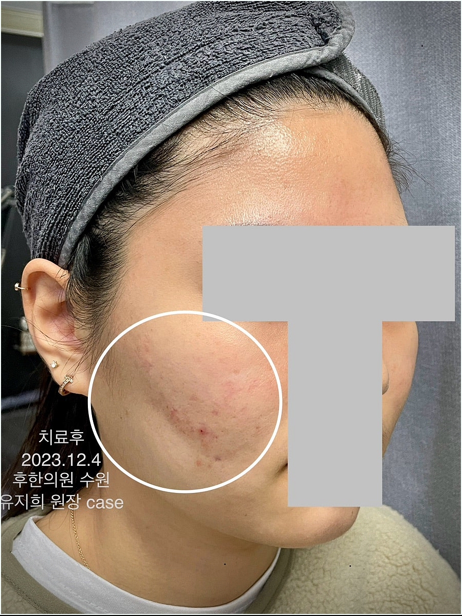 수원여드름흉터 치료종료