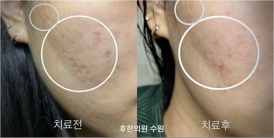 수원여드름흉터 옆볼패임 개선 셀카