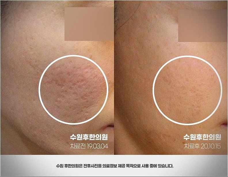 수원여드름흉터한의원 치료 전후 비교샷