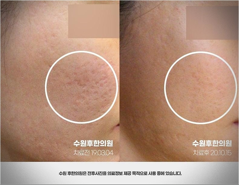 수원여드름흉터한의원 피부의 치료 전후 차이