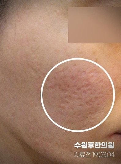 수원여드름흉터한의원 치료 전 19년도