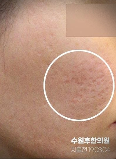 수원여드름흉터한의원 치료 전의 상태 19년도