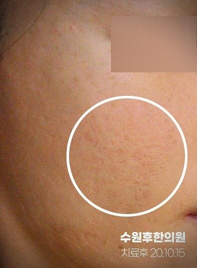 수원여드름흉터한의원 치료 후 회복된 피부