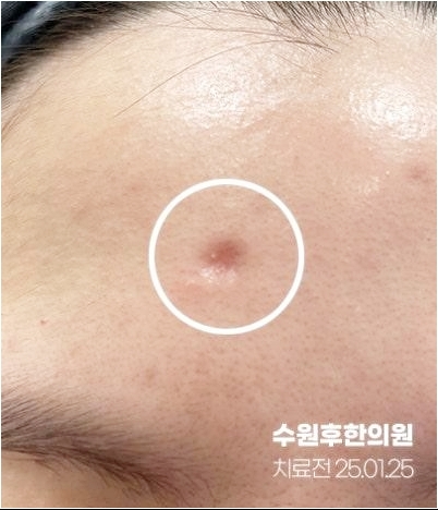 수원수두흉터 치료전