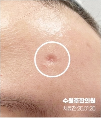 수원수두흉터 패임 깊은 이마 사진