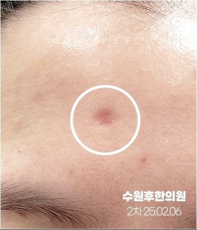 수원수두흉터 새살침 2차 후