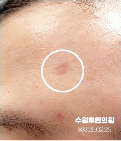 수원수두흉터 새살침 두번째 후 약간 차오른 사진