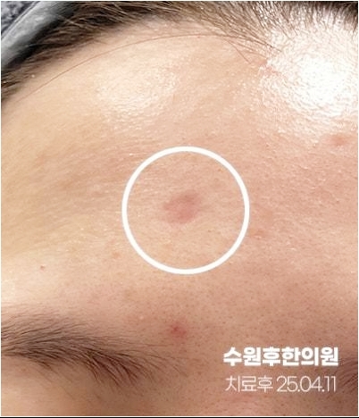 수원수두흉터 새살침 3차후