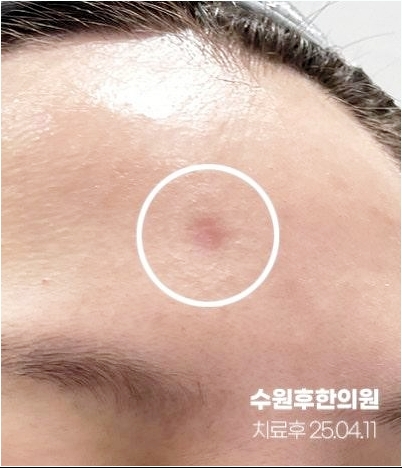 수원수두흉터 트랜스테라피 4차 후