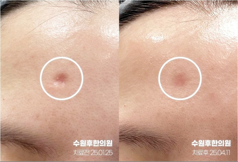 수원수두흉터 치료 후 정면