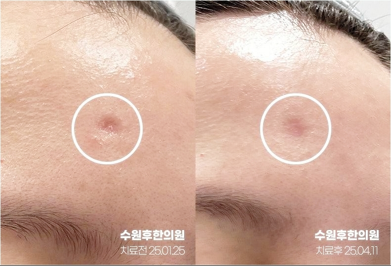 수원수두흉터 치료 후 측면 사진