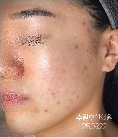 수원여드름자국 치료전