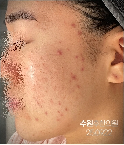 수원여드름자국 치료전 울긋불긋한 사진