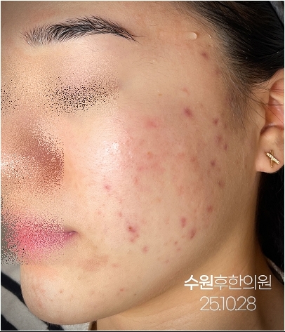 수원여드름자국 치료 중 사진