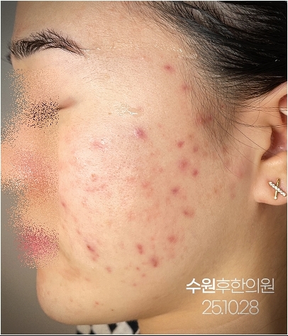 수원여드름자국 치료를 받으며 다소 호전