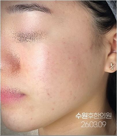 수원여드름자국 치료 후