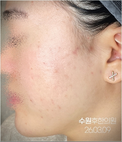 수원여드름자국 치료 종료 후 깨끗한 사진