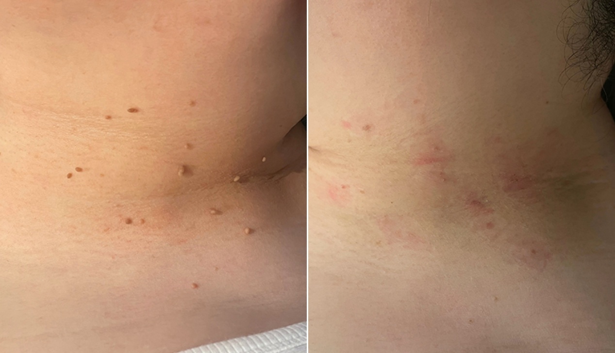 목 쥐젖 제거 전후 비교 사진