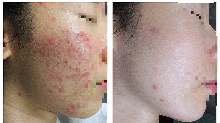 수원여드름피부과 여드름 치료 전후 비교 사진, 볼 부위 붉은 염증성 병변이 정리된 모습