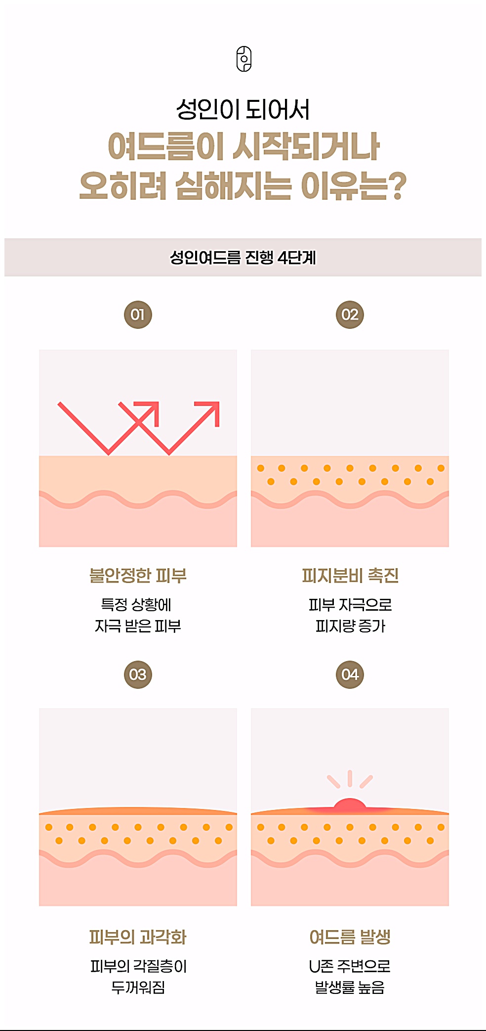 성인이 되어서 여드름이 시작되거나 오히려 심해지는 이유