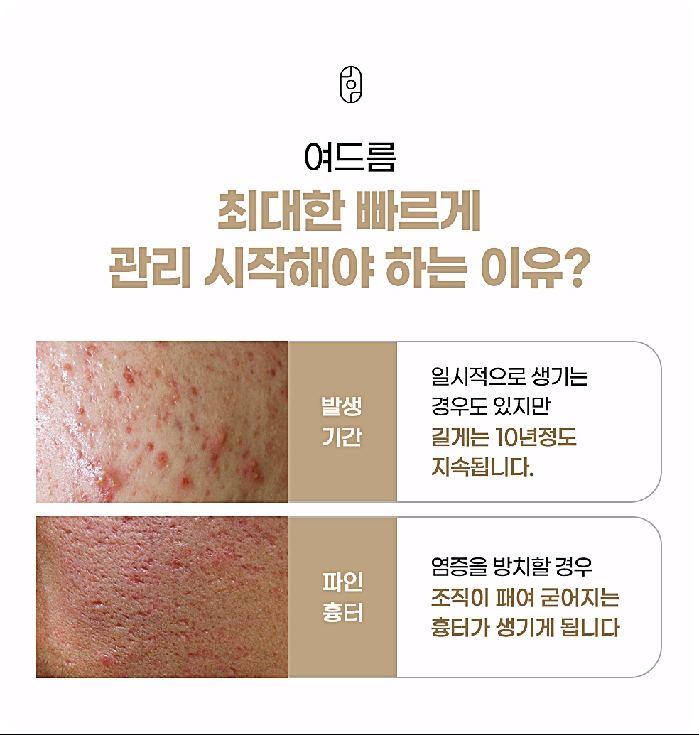수원여드름피부과 들러서 최대한 빠르게 여드름 치료 관리해야 하는 이유