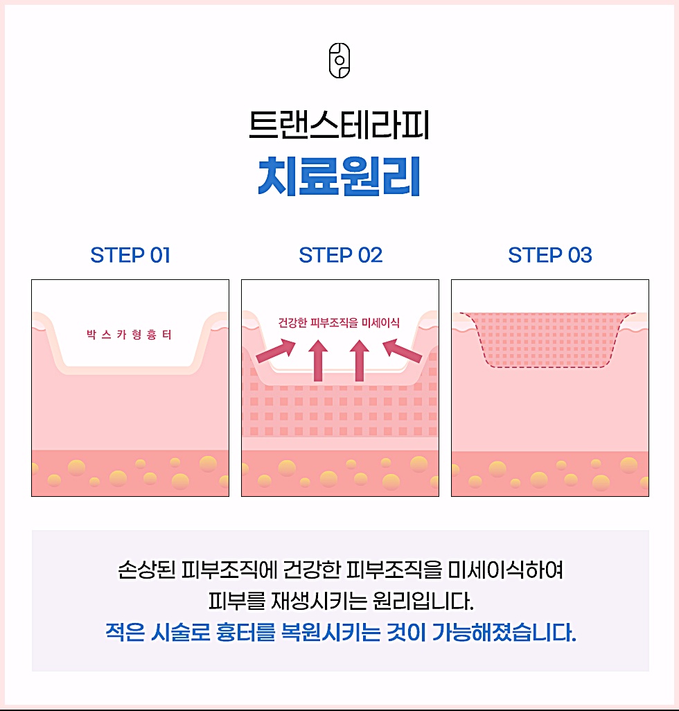 트랜스테라피 치료원리 박스카형 흉터에 건강한 피부조직 미세이식하는 단계별 설명