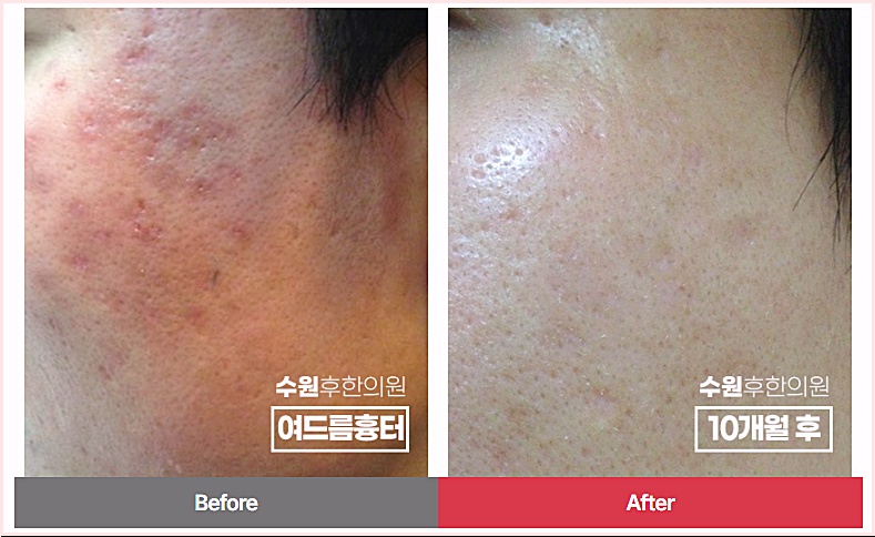 수원흉터치료 광대 부위 여드름흉터 10개월 치료 전후 비교