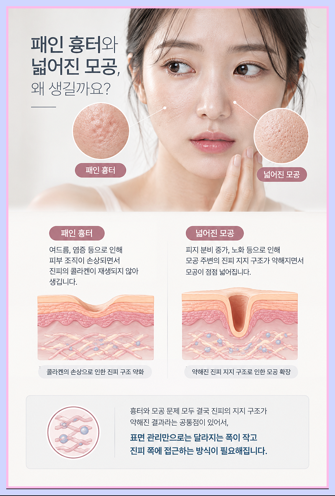 수원쥬베룩 패인 흉터 모공 원인