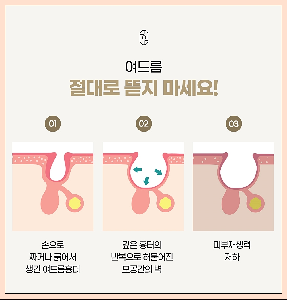 여드름 압출의 중요성 이미지
