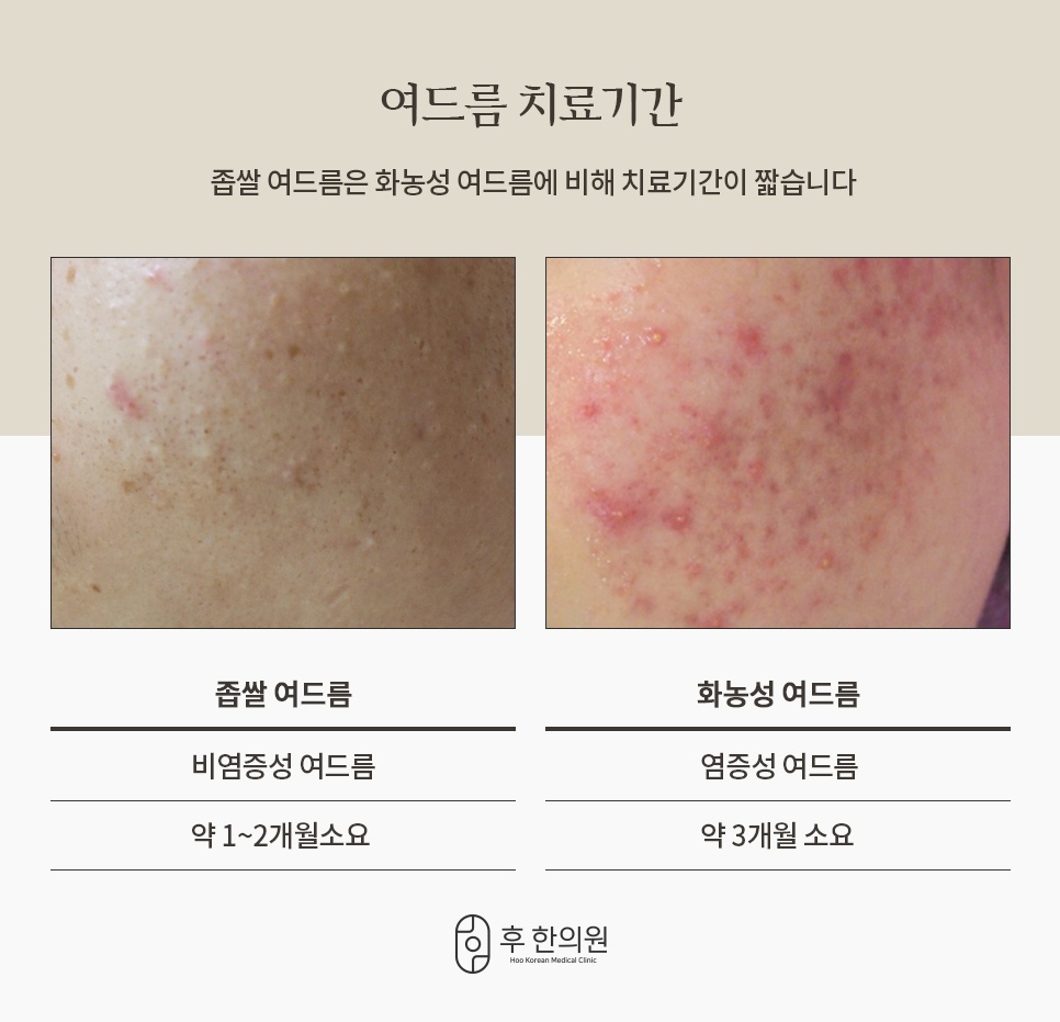 좁쌀 여드름은 약 1~2개월, 화농성 여드름은 약 3개월로 나눈 치료기간 비교
