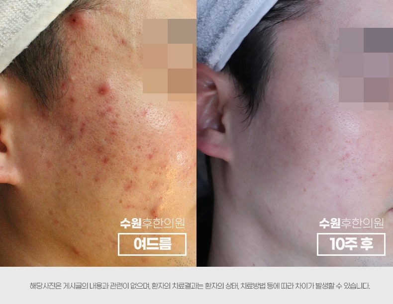 수원 여드름 치료 전후