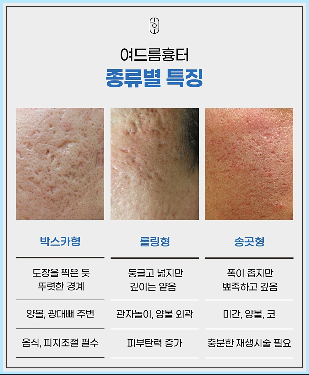 여드름흉터 종류별 특징 정리 이미지