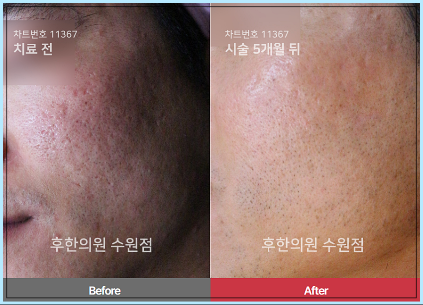 후한의원 수원점 여드름흉터 치료 케이스 사례