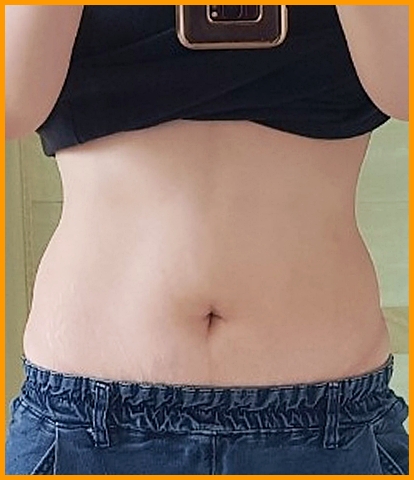 수원다이어트약 1개월 복용 후, 평평하게 정리된 복부 라인